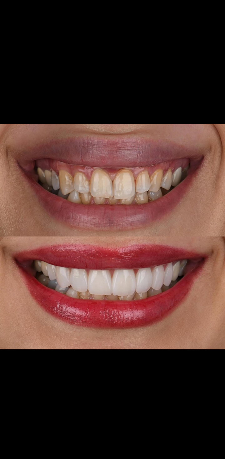 After treatment